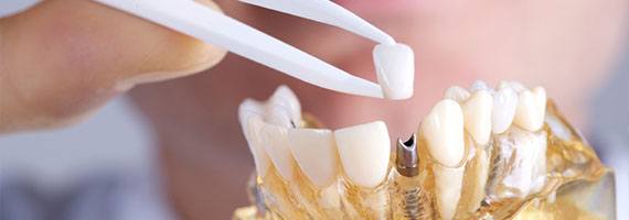 Learn more about Dental Implants